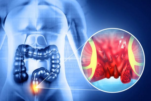 Haemorrhoids (piles) on scientific background. 3d illustration