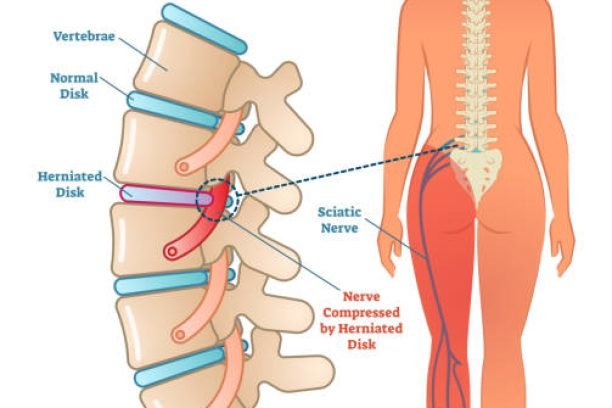 Sciatica medical health care vector illustration scheme with lower spine and sciatic nerve pain in leg. Backbone diagram with vertebrae, disks and nerves. Full woman patient body from back.